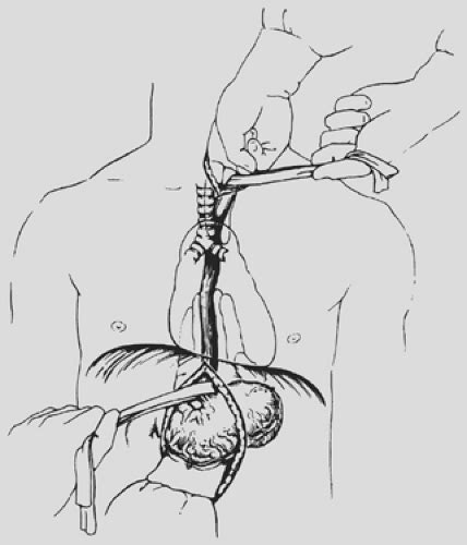 • esophageal mobilization • gastric mobilization • lymphadenectomy • conduit formation • reconstruction. Transhiatal Esophagectomy Without Thoracotomy | Thoracic Key