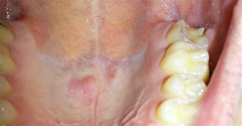 For example, some spots appear as painless tiny white granules and are visible when the lips are stretched. Tiny Bumps On Mouth Roof : Amazing Tips To Get Rid Of ...