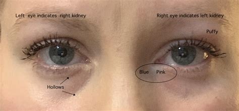 This eye creates an image that is sharp enough that motion of the eye can cause significant blurring. Kidney Stones, Water Retention and Face Reading - Rebecca Wood