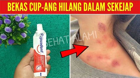 Cara menghilangkan bruntusan di leher dan cara menghilangkan leher hitam pada orang gemuk bisa dicoba dengan kedua bahan ini sebagaimana menghilangkan daki. CARA MENGHILANGKAN BEKAS CUPANG DI LEHER DALAM 3 MENIT ...