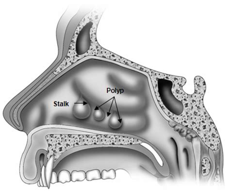 Nasal polyps are the most common tumors of the nasal cavity. Nasal Polyps