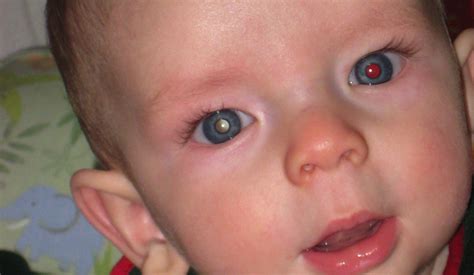 Abrupt onset of vision problems, such double vision. White eyes in photos may be sign of cancer | The Baylor Lariat