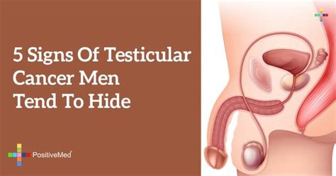 These nodules or masses are usually painless. 5 Signs of Testicular Cancer Men Tend to Hide - PositiveMed