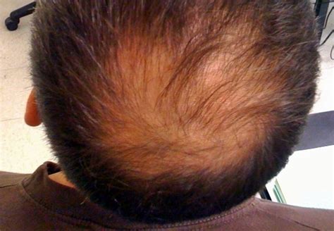 Among identical twins, if one is affected, the other has about a 50% chance of also being affected. Alopecia: problema multifactorial | El Heraldo de ...