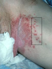 If skin breakdown occurs, the rash may weep fluid and become infected. Derm 2 at Baylor College of Medicine - StudyBlue