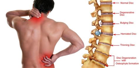 It can affect the areas of the lower back and knees. Back Pain Treatment and Exercises - Physiotherapy Canberra - TM Physio