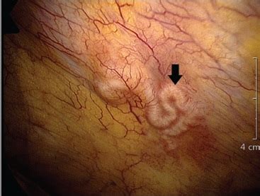 Penyakit yang disebabkan jamur pada manusia disebut mikosis, yaitu mikosis superficial dan mikosis sistemik. Sparganosis, Penyakit Tropis yang Diabaikan pada Ular ...
