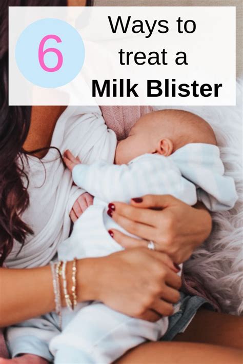 While camel milk may seem foreign to many inhabitants of north america, in the middle east it's a dietary staple that numerous people couldn't do without. 6 Tips To Get Rid Of A Milk Blister (Bleb | Milk blister ...