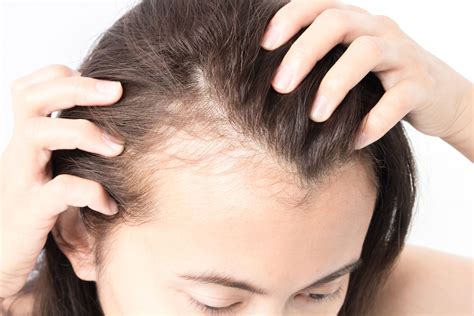 Pakar rambut gugur | dapatkan pelebat rambut paling berkesan di malaysia. Tips rawat rambut gugur secara semula jadi - Santai sini