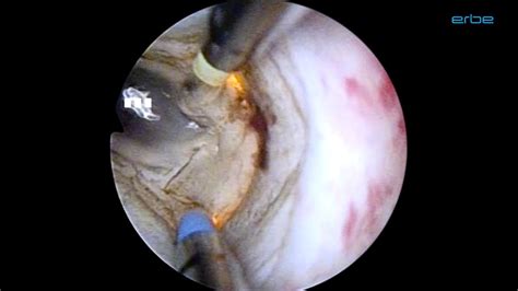 Highs are periods of mania, while lows are periods of depression. Bipolar TURP with VIO® 3 - Medical Videos