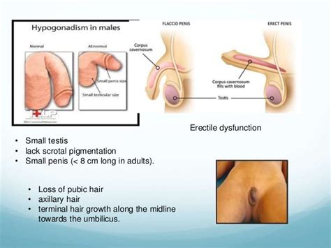 Hypogonadism occurs when your sex glands produce little or no sex hormones. Male Hypogonadism