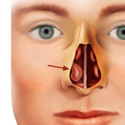 Nasal polyps usually grow in the shape of a teardrop. Raleigh Capitol Sinus and Allergy Center > Services ...