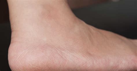 This foot file is effective at sloughing away dead skin but not too harsh that it will leave your feet. Home Remedies for Extremely Dry Feet | LIVESTRONG.COM