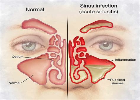 They may grow larger, however. Houston Sinus Center | About ENT Problems: Common Reasons ...