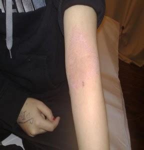 Curare la Dermatite Atopica con la Riflessologia Plantare ...
