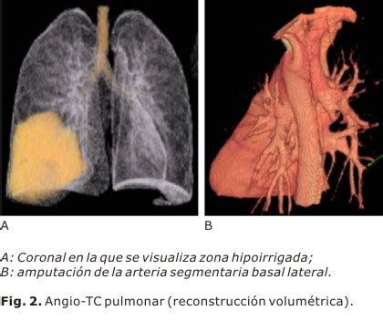 La radiografía de tórax suele ser la prueba principal que se realiza cuando un paciente. TEP on emaze