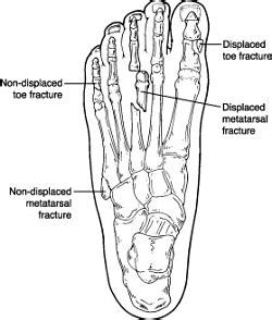 A description of big toe joint pain due to hallux limitus and surgical treatment including before and after pictures of hallux limitus surgery. BRÆKKET TÅ - Behandling af brækket storetå eller lilletå