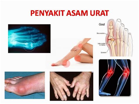 Melansir buku asam urat (2009) oleh dr. Cara Mengobati Berbagai Macam Penyakit: Diagnosa Asam Urat