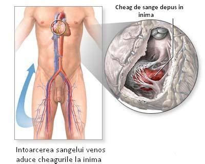 Poze medicale Tromboza venoasa profunda