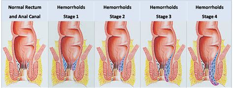 Pain is insignificant and much. hemorrhoid surgery