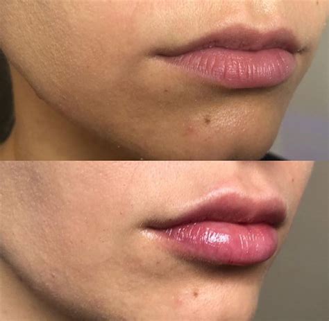 Every lip filler appointment starts with a bespoke consultation to discuss your desired aesthetic results. Lip Injections | Peace. Love. Med.