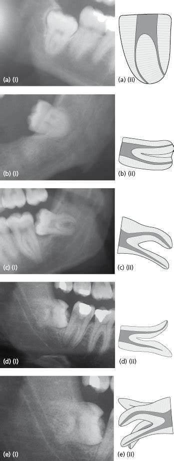 What does conical tooth mean? 9: Management of Impacted Teeth | Pocket Dentistry