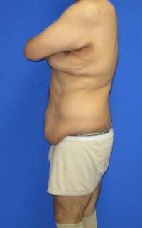 Awake tummy tucks are done in the office, under local. Fresno Avelar Tummy Tuck Procedure Before and After Photos ...