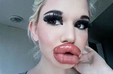 lips biggest woman bulgarian injection fillers her 20th undergoes pursuit part andrea she bigger