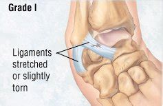 You repeat this process throughout the day for 3 days. Ankle Sprain Guide: Causes, Symptoms and Treatment Options