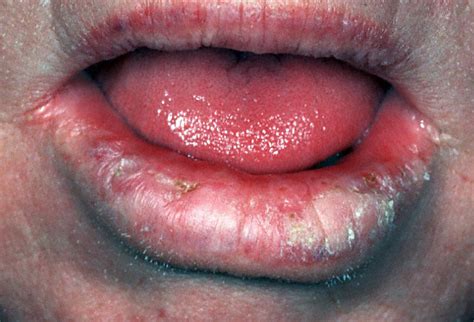 In the early stages of tongue cancer, especially with cancer at the base of the tongue, you might not notice any symptoms. Medical Pictures Info - Mouth Cancer