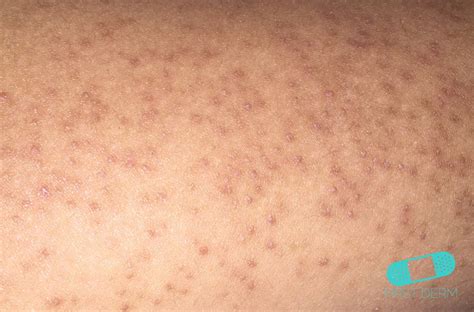 The tendency to keratosis pilaris has genetic origins, with autosomal dominant inheritance (up to half of the children of an affected individual may display signs of keratosis. Keratosis Pilaris treatment for your Arms - Online Dermatology