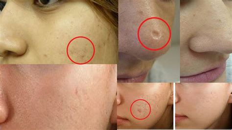 Menurut penelitian, kulit wajah terbukti lebih sensitif dibandingkan area kulit. Obat Penghilang Bekas Jerawat Yang Ampuh Dan Cepat ...