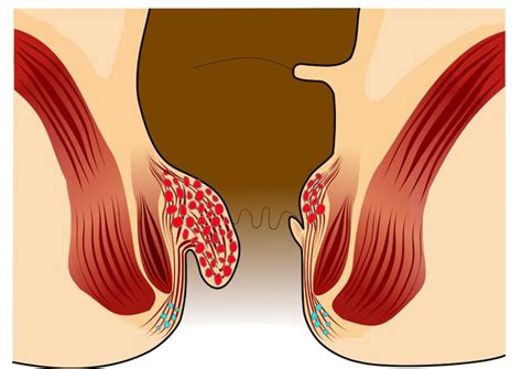 Typisch ist bei größeren hämorrhoiden ein starkes jucken, manchmal auch ein brennen, nässen und eine irritation der haut im analbereich. Hämorrhoiden HILFE - Behandlung - ALLES was sie zu ...