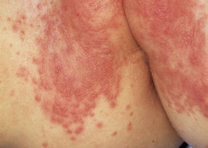Rashes basic dermatology curriculum content for this module was 58 neonatal hsv: Medical Pictures Info - Diaper Rash