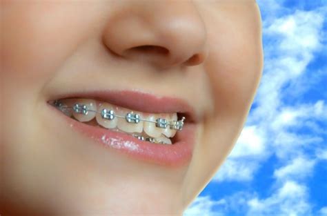 Bei einer festen zahnspange von innen werden lingualbrackets (lingual = zungenseitig) auf die zahninnenseite geklebt. Zahnschmuck - und Zahnzusatzversicherung?