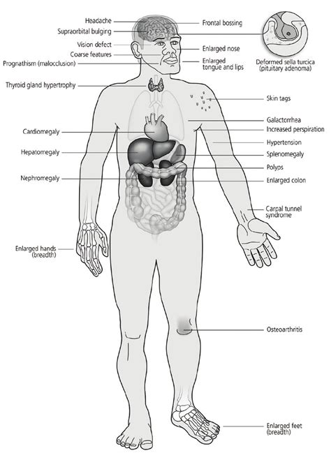 Acupuncture has been used in other species to treat the chronic pain of arthritis. Signs and symptoms of acromegaly. | Download Scientific ...