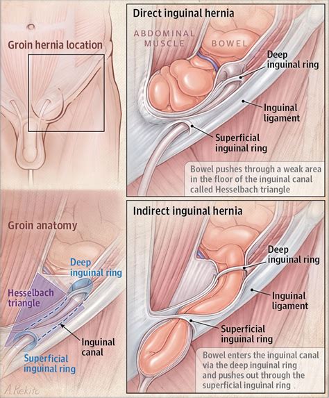 The groin is the area that lies between the abdomen (stomach) and thighs. Anatomy Male Groin . Anatomy Male Groin Groin Hernia ...