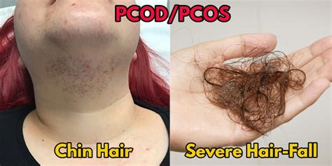 Sarcoidosis may cause skin problems. 5 Best Treatments for Hair Loss Due to PCOS ...