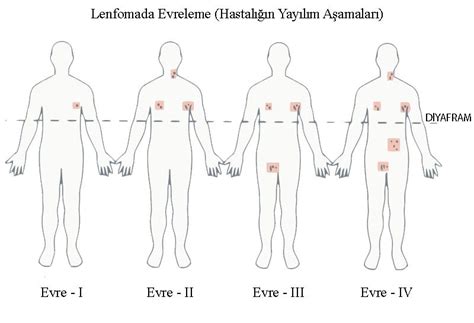 Lenfoma i̇le nasıl bir i̇lgisi vardır? Lenfoma Kanseri