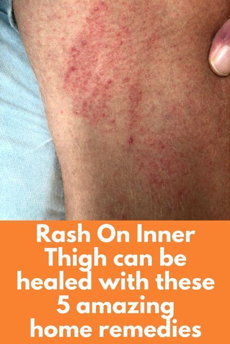 Babies, infants, toddlers, and teens can also be. Rash On Inner Thigh can be healed with these 5 amazing ...
