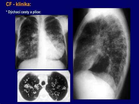 Plicní cystická fibróza má u dětí i dospělých podobné příznaky: PPT - Cystická fibróza (mukoviscidóza) PowerPoint ...