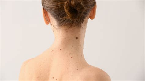 A pigmented lesion is a general term that includes normal moles, sun freckles or age spots (lentigines). What it really means if you have a mole in these places