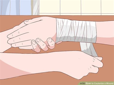 Moreover, things like trouble in breathing or throwing up after a spider bite might need immediate treatment. How to Cauterize a Wound (with Pictures) - wikiHow