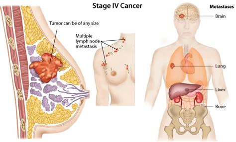 Cancer cells in the circulation may try to stick to platelets to form clumps to give themselves some protection. Where does Breast Cancer Spread To? | New Health Advisor