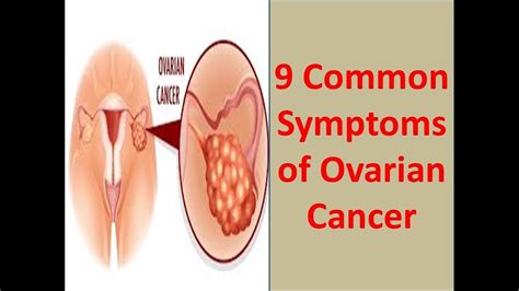 Many people currently use ovarian cancer as an umbrella term to include not only ovarian cancer but also fallopian tube cancer and primary peritoneal cancer. 9 Symptoms of Ovarian Cancer-How Recognizing Ovarian ...