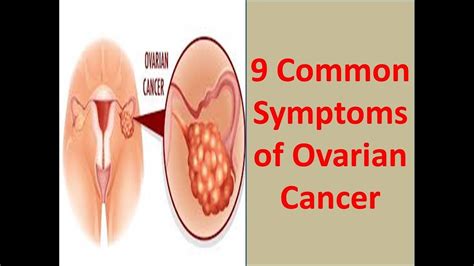 Ovarian cancer as its name suggests is a cancer that originates in the ovaries. 9 Symptoms of Ovarian Cancer-How Recognizing Ovarian ...