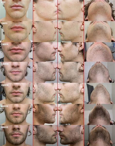 The dramatic before and after results speak for themselves. Anyone ever tried Minoxidil for beard growth? - NeoGAF