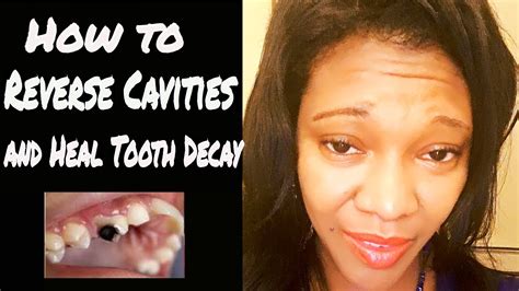 But after knowing that now you can reverse tooth decay by replenishing the enamel, the first question that pops up in your mind is 'how to reverse the tooth. How to Reverse Cavities Naturally and Heal Tooth Decay ...