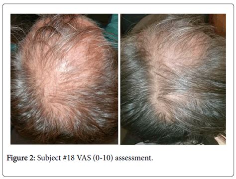 Extreme zinc deficiency can cause hair loss. 37BC62B1-FDA1-439E-A4F1-FF5715FAD91B.png