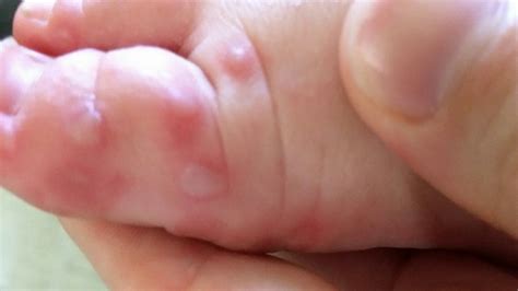 Hand, foot, and mouth disease (hfmd) is a common infection in children that causes sores called ulcers inside or around their mouth and a rash or blisters on their hands, feet, legs, or buttocks. Difference Between Chickenpox and Hand Foot and Mouth ...